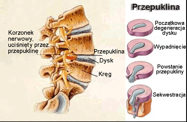 przepuklyna